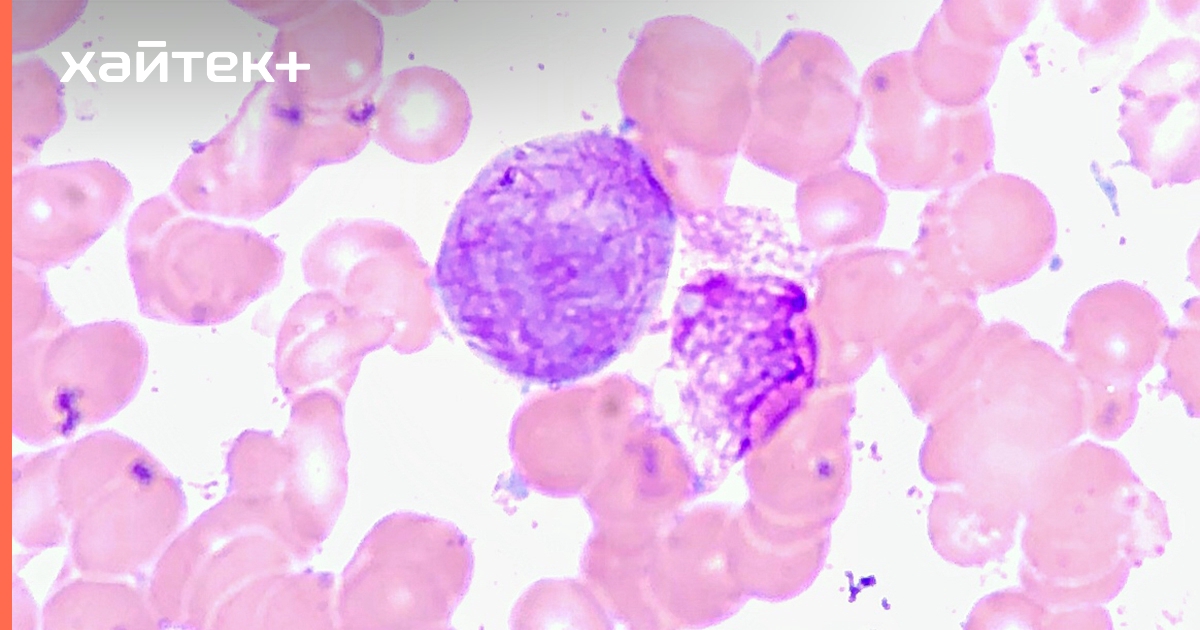 Острый миелолейкоз картина крови