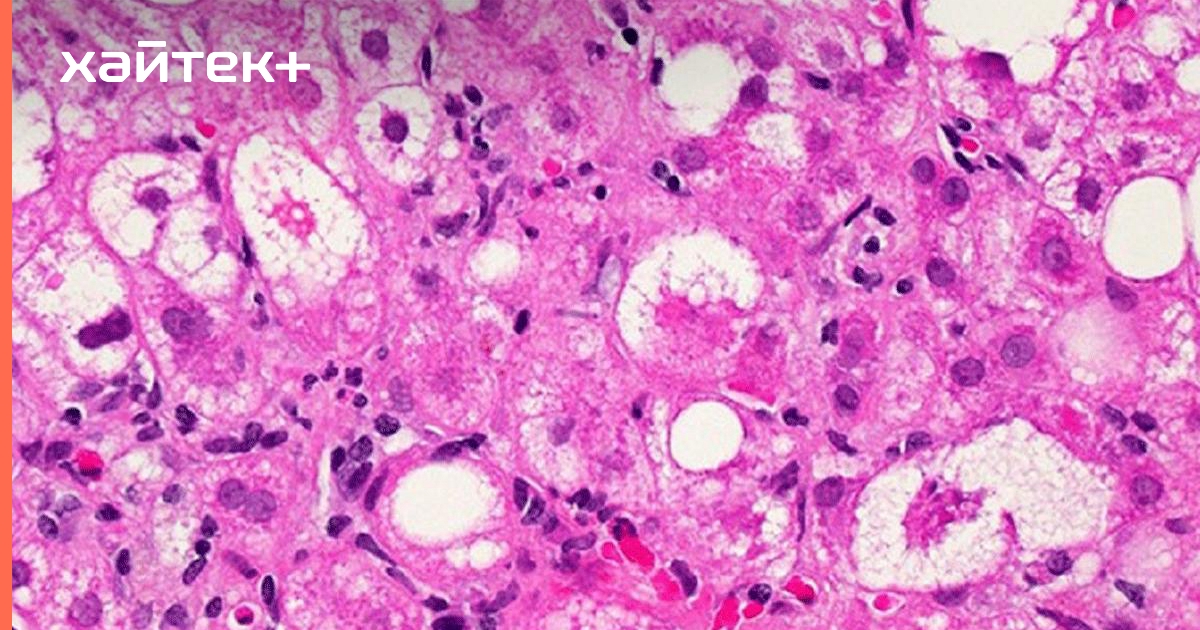 Разработано эффективное лекарство против жировой болезни печени