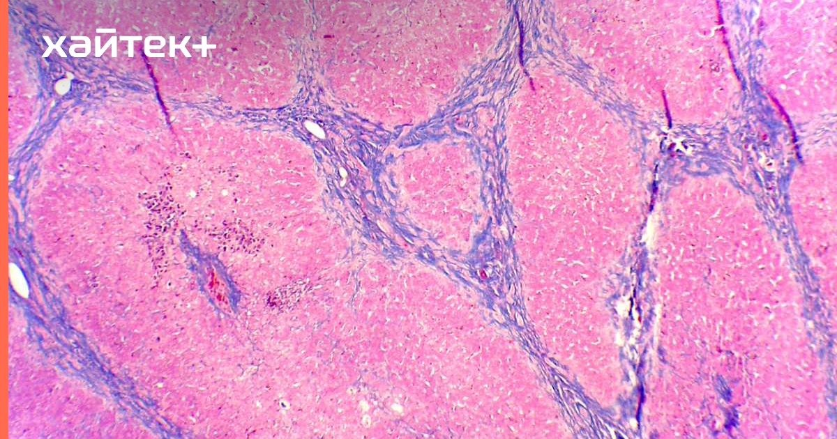 New research proves it is possible to restore liver function and avoid complications caused by fibrosis