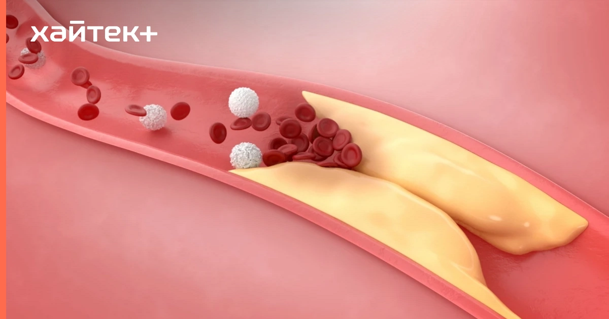 CRISPR снизила уровень холестерина у пациентов с резистентностью на 80%