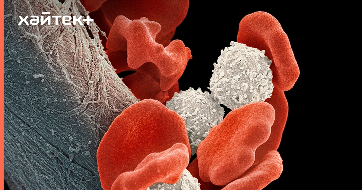 Хронические заболевания крови. Онкология клетки крови. Вид белокровие кровь фото.